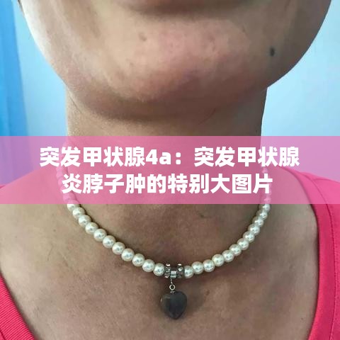 突发甲状腺4a：突发甲状腺炎脖子肿的特别大图片 