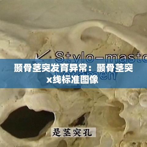 颞骨茎突发育异常：颞骨茎突x线标准图像 